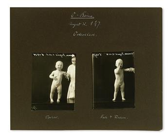 PEDIATRIC ORTHOPEDICS. Album of 84 silver print photographs of 21 patients before and after treatment. Germany, circa 1928-29